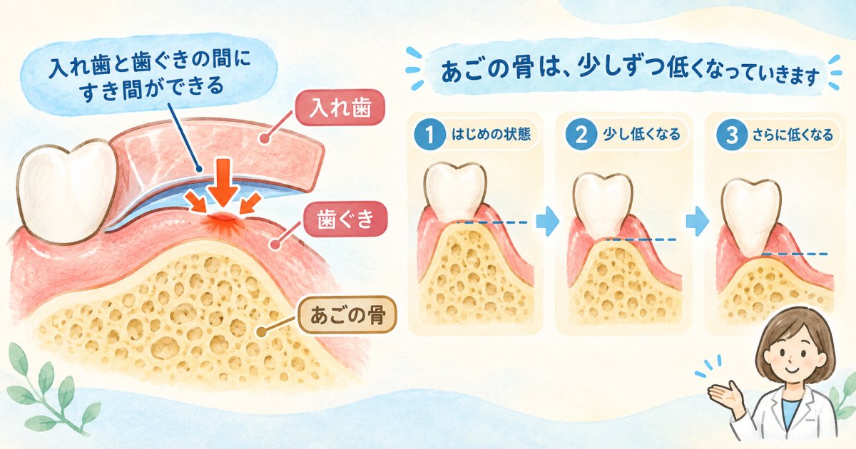 合わない入れ歯の放置リスクとは？顎の骨が痩せる医学的な仕組み