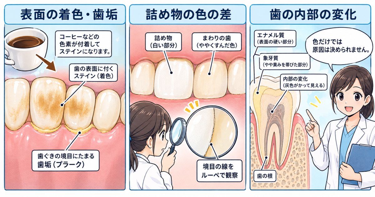 前歯1本が暗く見える理由は、着色だけとは限らない