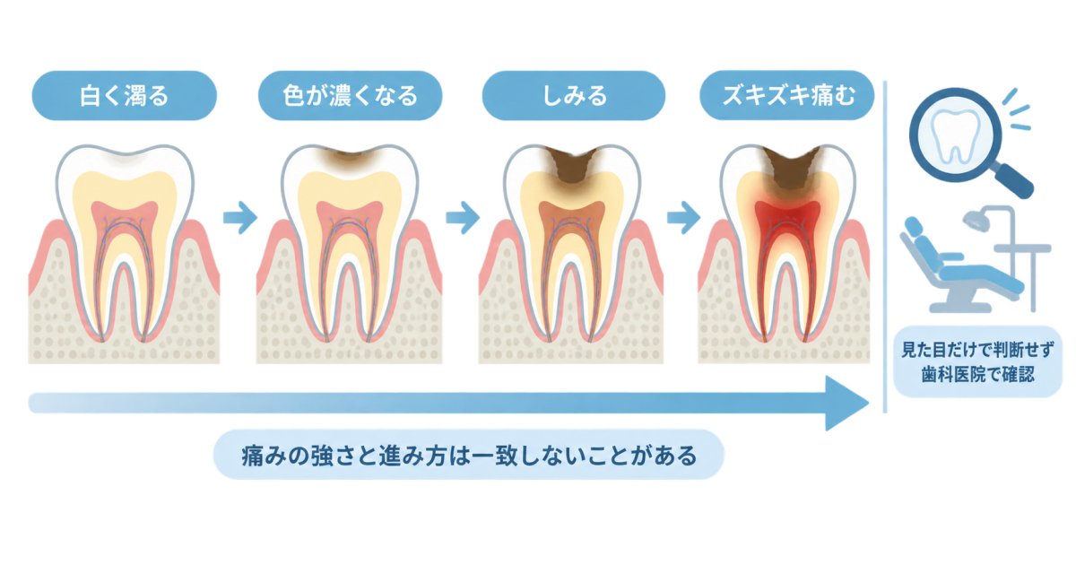奥歯の白っぽい変化はむし歯?見た目と症状の目安